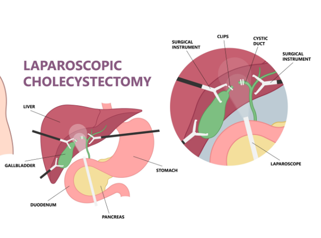 Laparoscopic Cholecystectomy
